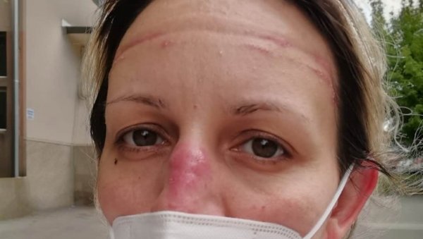РАНЕ НА ЛИЦУ МЕДИЦИНСКЕ СЕСТРЕ БОЈАНЕ: Она лечи Србе од короне на КиМ, и има апел који морате да прочитате РАНЕ НА ЛИЦУ МЕДИЦИНСКЕ СЕСТРЕ БОЈАНЕ: Она лечи Србе од короне на КиМ, и има апел који морате да прочитате