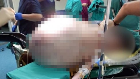 (УЗНЕМИРУЈУЋИ ВИДЕО) ИЗВАДИЛИ ЈОЈ ТУМОР ОД 90 КИЛОГРАМА! Невероватна операција у Скопљу, највећи измерени у Европи (УЗНЕМИРУЈУЋИ ВИДЕО) ИЗВАДИЛИ ЈОЈ ТУМОР ОД 90 КИЛОГРАМА! Невероватна операција у Скопљу, највећи измерени у Европи