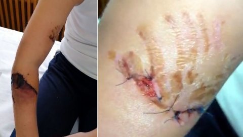 ПАС ИЗУЈЕДАО КОМШИЈИ РУКУ: Ветеринарској инспекцији стигло 76 пријава напада власничких паса ПАС ИЗУЈЕДАО КОМШИЈИ РУКУ: Ветеринарској инспекцији стигло 76 пријава напада власничких паса