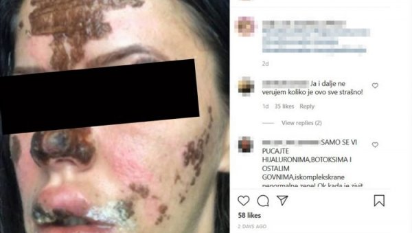 (УЗНЕМИРУЈУЋЕ) БЕОГРАЂАНКЕ УНАКАЖЕНЕ У САЛОНУ ЛЕПОТЕ: Оне тврде су биле жртве докторке Олгице (ФОТО) (УЗНЕМИРУЈУЋЕ) БЕОГРАЂАНКЕ УНАКАЖЕНЕ У САЛОНУ ЛЕПОТЕ: Оне тврде су биле жртве докторке Олгице (ФОТО)