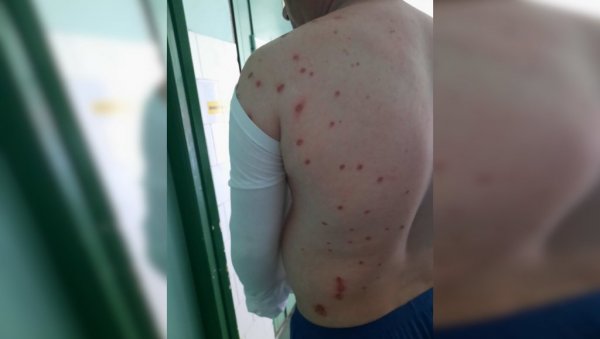 ПРЕЖИВЕО УДАР ОД 110.000 ВОЛТИ: Радник у Бору “упао” у струјни лук ПРЕЖИВЕО УДАР ОД 110.000 ВОЛТИ: Радник у Бору “упао” у струјни лук