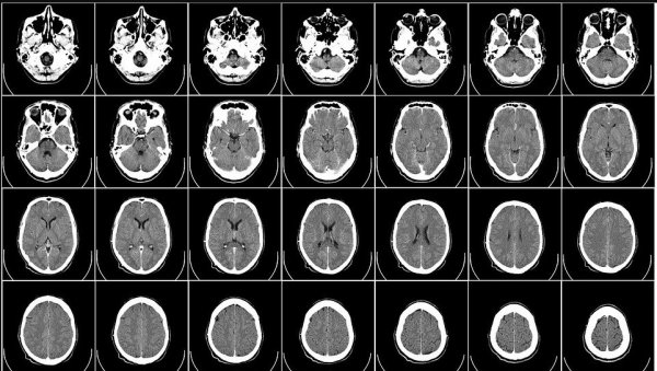 ОБРАТИТЕ ПАЖЊУ: Шест симптома рака мозга, ове промене могу бити знак за узбуну