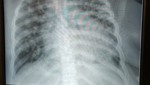 TRI VIRUSA HARAJU SRBIJOM: Jedan je posebno opasan po život - Moj mrtvozornik u januaru i februaru ima duplo više posla TRI VIRUSA HARAJU SRBIJOM: Jedan je posebno opasan po život - Moj mrtvozornik u januaru i februaru ima duplo više posla