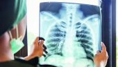 KAŠALJ UKAZUJE NA UPALU PLUĆA : Lekari upozoravaju - zbog korone pazite na ove simptome KAŠALJ UKAZUJE NA UPALU PLUĆA : Lekari upozoravaju - zbog korone pazite na ove simptome