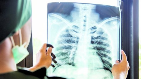 SMRTNOST OD TBC U PORASTU: Zabrinjavajući podaci o broju preminulih od tuberkuloze SMRTNOST OD TBC U PORASTU: Zabrinjavajući podaci o broju preminulih od tuberkuloze