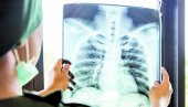 SMRTNOST OD TBC U PORASTU: Zabrinjavajući podaci o broju preminulih od tuberkuloze SMRTNOST OD TBC U PORASTU: Zabrinjavajući podaci o broju preminulih od tuberkuloze