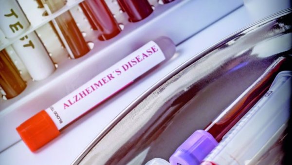АЛЦХАЈМЕРА ОТКРИВАЈУ ВЕШТАЧКОМ ИНТЕЛИГЕНЦИЈОМ: Дијагностика ће помоћи у лечењу АЛЦХАЈМЕРА ОТКРИВАЈУ ВЕШТАЧКОМ ИНТЕЛИГЕНЦИЈОМ: Дијагностика ће помоћи у лечењу