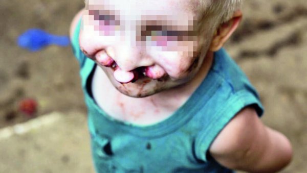 ОПЕРИСАН МАЛИ ПАВЛЕ: За седам дана иде на кућно лечење - следећи захват за три месеца ОПЕРИСАН МАЛИ ПАВЛЕ: За седам дана иде на кућно лечење - следећи захват за три месеца