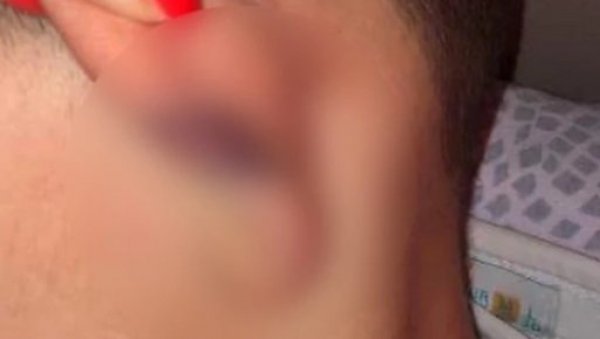 УЖАС У ВРАЊУ: Другови брутално претукли дечака (8) усред прославе рођендана УЖАС У ВРАЊУ: Другови брутално претукли дечака (8) усред прославе рођендана