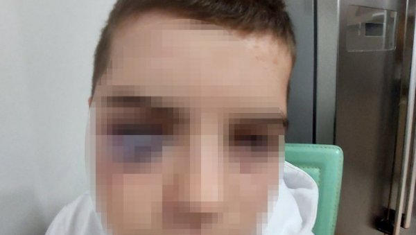 ДЕЧАКУ ОКО МОДРО И ЗАТВОРЕНО: Отац из Сурдулице пријавио да му је дете (15) жртва вршњачког насиља (ФОТО) ДЕЧАКУ ОКО МОДРО И ЗАТВОРЕНО: Отац из Сурдулице пријавио да му је дете (15) жртва вршњачког насиља (ФОТО)