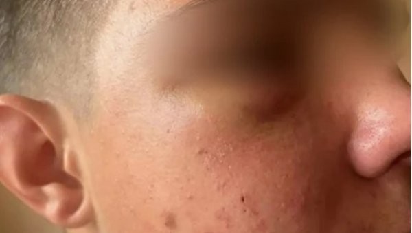 ПОЛОМИЛИ МУ ВИЛИЦУ И ЈАГОДИЧНУ КОСТ: Још један случај вршњачког насиља у Новом Пазару ПОЛОМИЛИ МУ ВИЛИЦУ И ЈАГОДИЧНУ КОСТ: Још један случај вршњачког насиља у Новом Пазару