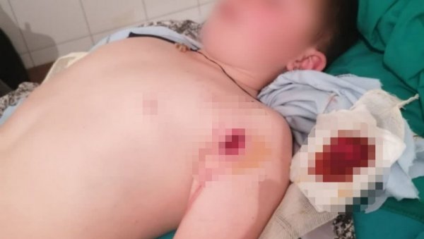 ПОГЛЕДАЈТЕ РАНУ МАЛОГ СТЕФАНА: Узнемирујућа фотографија из Штрпца (ФОТО) ПОГЛЕДАЈТЕ РАНУ МАЛОГ СТЕФАНА: Узнемирујућа фотографија из Штрпца (ФОТО)