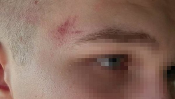 УДАРАЛИ МЕ И ШУТИРАЛИ ГДЕ СУ СТИГЛИ: Настављен терор Албанаца над српском децом на КиМ, Лазар Милутиновић (15) после напада у Сувом Долу УДАРАЛИ МЕ И ШУТИРАЛИ ГДЕ СУ СТИГЛИ: Настављен терор Албанаца над српском децом на КиМ, Лазар Милутиновић (15) после напада у Сувом Долу