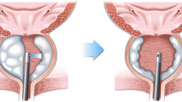 За проблеме са простатом ласерско лечење највиша је класа: У све четири филијале Ласер Меда у Србији и Бугарској
