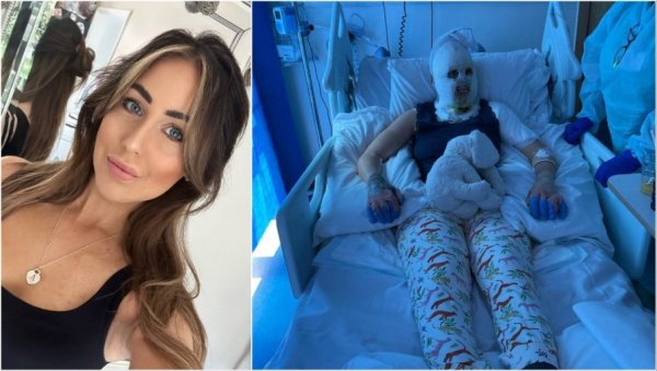ГРЕЈАЛИЦА ЈОЈ ЕКСПЛОДИРАЛА У ЛИЦЕ: Девојка задобила језиве повреде, лекари морали да је уведу у кому