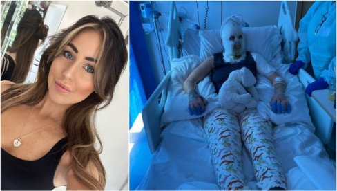 GREJALICA JOJ EKSPLODIRALA U LICE: Devojka zadobila jezive povrede, lekari morali da je uvedu u komu GREJALICA JOJ EKSPLODIRALA U LICE: Devojka zadobila jezive povrede, lekari morali da je uvedu u komu