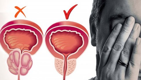 UVEĆANJE PROSTATE ZAVISI OD GODINA STAROSTI: Tulijum laser od 200 vati isparava prostatu bez obzira na njen obim UVEĆANJE PROSTATE ZAVISI OD GODINA STAROSTI: Tulijum laser od 200 vati isparava prostatu bez obzira na njen obim