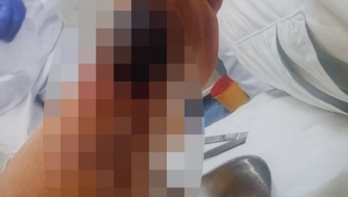 ŽENA ZAVRŠILA NA OPERACIJI I TRANSPLANTACIJI KOŽE: Saslušani kozmetičar i lekar opšte prakse, osumnjičeni za pogrešno lečenje ŽENA ZAVRŠILA NA OPERACIJI I TRANSPLANTACIJI KOŽE: Saslušani kozmetičar i lekar opšte prakse, osumnjičeni za pogrešno lečenje