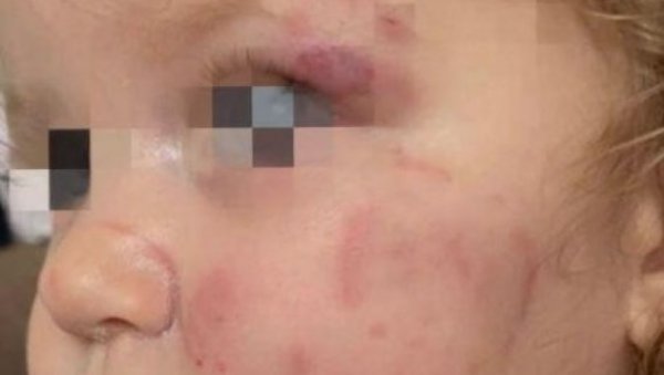 ДЕТЕ ИЗУЈЕДАЛО ВРШЊАКИЊУ У ВРТИЋУ: Ужас у Смедереву - Девојчица са озбиљним повредама хитно примљена у болницу ДЕТЕ ИЗУЈЕДАЛО ВРШЊАКИЊУ У ВРТИЋУ: Ужас у Смедереву - Девојчица са озбиљним повредама хитно примљена у болницу