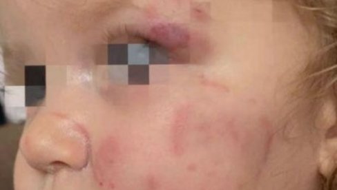 DETE IZUJEDALO VRŠNJAKINJU U VRTIĆU: Užas u Smederevu - Devojčica sa ozbiljnim povredama hitno primljena u bolnicu DETE IZUJEDALO VRŠNJAKINJU U VRTIĆU: Užas u Smederevu - Devojčica sa ozbiljnim povredama hitno primljena u bolnicu