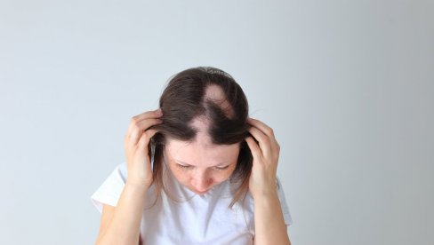 MUČI VAS OPADANJE KOSE: Oprez ako imate alopeciju, ona je odraz i vašeg zdravlja MUČI VAS OPADANJE KOSE: Oprez ako imate alopeciju, ona je odraz i vašeg zdravlja
