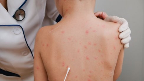 I DALJE PRETI ZABRANA BORAVKA U VRTIĆU: Epidemija malih boginja se širi u Crnoj Gori, a vakcinisanje dece sporo ide I DALJE PRETI ZABRANA BORAVKA U VRTIĆU: Epidemija malih boginja se širi u Crnoj Gori, a vakcinisanje dece sporo ide