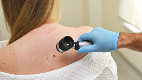 PRVI REZULTATI OBEĆAVAJU: Razvijen novi test za skrining raka kože PRVI REZULTATI OBEĆAVAJU: Razvijen novi test za skrining raka kože