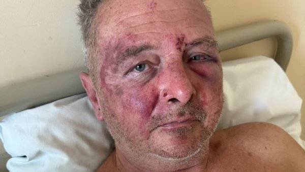 НАПАДНУТ И БРУТАЛНО ПРЕТУЧЕН ЧУВАР РИБЊАКА: Владимира тукли мотком по глави - има тешке повреде и подливе НАПАДНУТ И БРУТАЛНО ПРЕТУЧЕН ЧУВАР РИБЊАКА: Владимира тукли мотком по глави - има тешке повреде и подливе