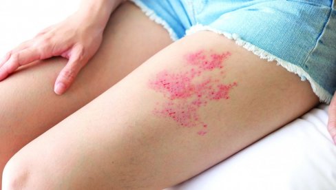 UPOZORENJE LEKARA: Kada prehlada oslabi organizam, lako izbije herpes UPOZORENJE LEKARA: Kada prehlada oslabi organizam, lako izbije herpes