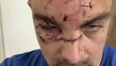UZNEMIRUJUĆE! Ovako izgledaju jezive povrede koje je Karlik DŽons naneo čoveku flašom (FOTO)