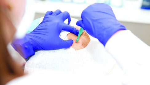 REZULTATI ZA SAMO 20 MINUTA: Biopsija tumora pomoću nano-igličnog flastera