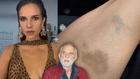 SVE IZNELA JAVNO Lazina Anica objavila fotografije u ogromnim modricama: Boli! (FOTO)