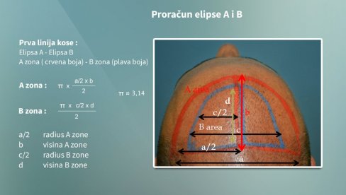 АХТ метод: Нова ера у трансплантацији косе