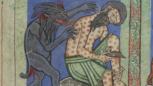 POZNATO STANJE ČOVEKA ZARAŽENOG GUBOM U HRVATSKOJ: Celo telo mu u flekama, evo da li može doći do epidemije