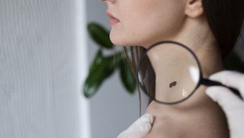 OPREZNO SA PROMENAMA NA KOŽI: Postoji samo jedan siguran način uklanjanja mladeža (FOTO)