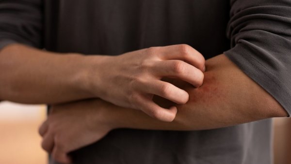 НЕКАД ЈЕ ЧАК ЗНАК И УНУТРАШЊИХ БОЛЕСТИ: Не занемарујте када вас сврби кожа, можда имате неке од ових проблема