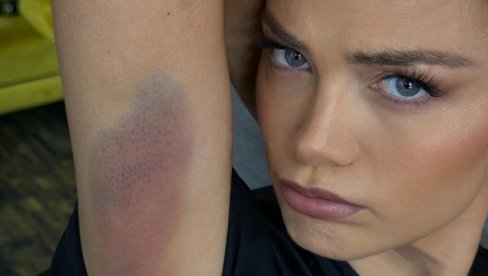 ЦЕЛО ТЕЛО У ПОДЛИВИМА: Милица Павловић се повредила на снимању спотова за нови албум Цака (ФОТО)