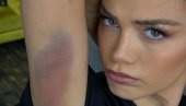 ЦЕЛО ТЕЛО У ПОДЛИВИМА: Милица Павловић се повредила на снимању спотова за нови албум Цака (ФОТО)